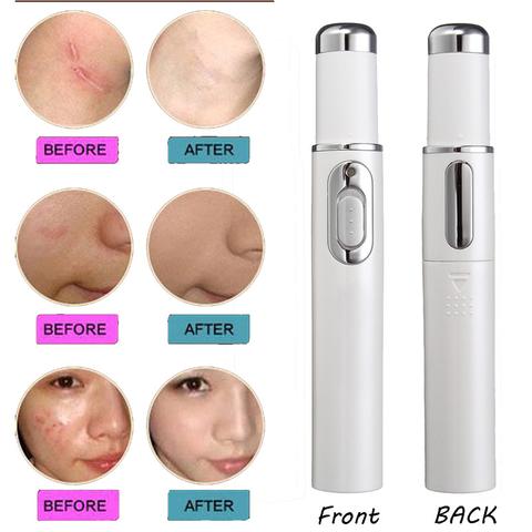 Stylo Laser Anti-Acné & Soin de la Peau