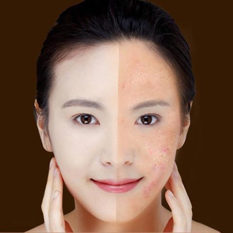 Stylo Laser Anti-Acné & Soin de la Peau